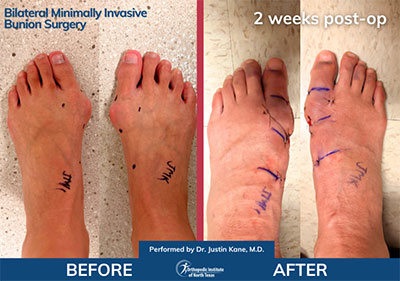 Minimally Invasive Bunion Surgery Bilateral - Performed by Dr. Justin Kane at OINT