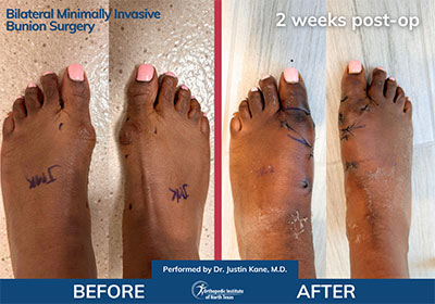 Minimally Invasive Bunion Surgery Bilateral - Performed by Dr. Justin Kane at OINT