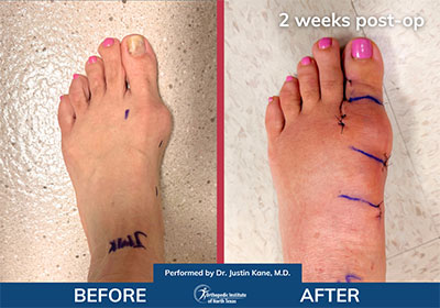 Minimally Invasive Bunion Surgery Bilateral - Performed by Dr. Justin Kane at OINT