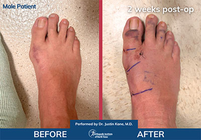 Minimally Invasive Bunion Surgery Bilateral - Performed by Dr. Justin Kane at OINT