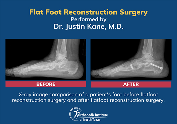 X-ray image comparison of a patient’s foot before flatfoot reconstruction surgery and after flatfoot reconstruction surgery.