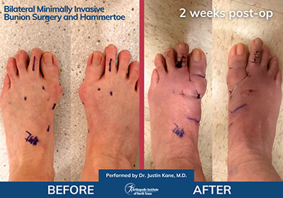 Minimally Invasive Bunion Surgery - Performed by Dr. Justin Kane at OINT