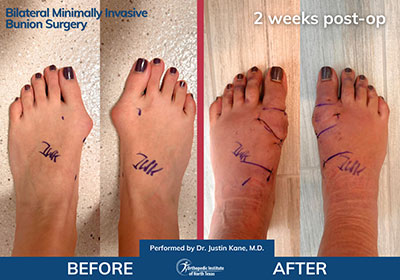 Minimally Invasive Bunion Surgery and Hammertoe Surgery - Performed by Dr. Justin Kane at OINT