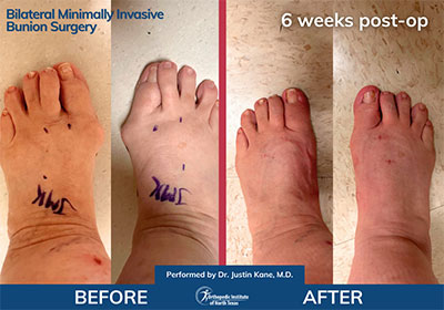 Minimally Invasive Bunion Surgery - Performed by Dr. Justin Kane at OINT