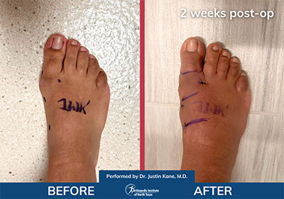 Minimally Invasive Bunion Surgery - Performed by Dr. Justin Kane at OINT