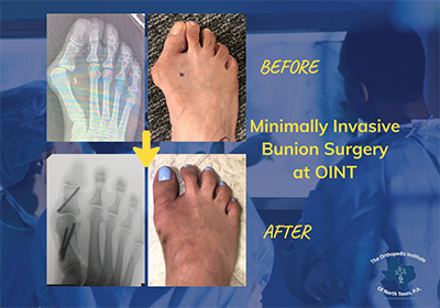 Minimally Invasive Bunion Surgery Dallas, TX | Ankle Ligament Tear ...
