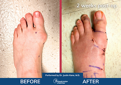 Minimally Invasive Bunion Surgery Bilateral - Performed by Dr. Justin Kane at OINT