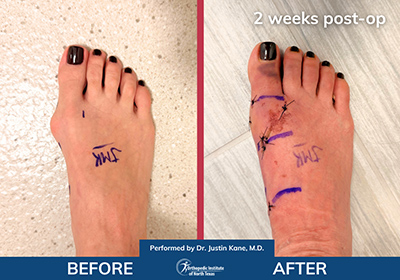 Minimally Invasive Bunion Surgery Bilateral - Performed by Dr. Justin Kane at OINT