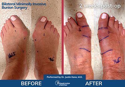 Minimally Invasive Bunion Surgery - Performed by Dr. Justin Kane at OINT