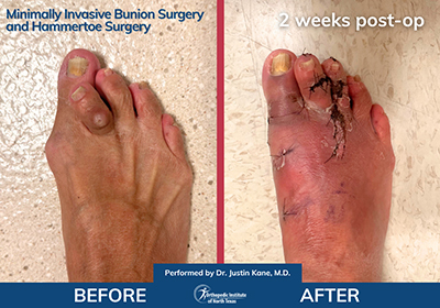 Minimally Invasive Bunion Surgery and Hammertoe Surgery - Performed by Dr. Justin Kane at OINT