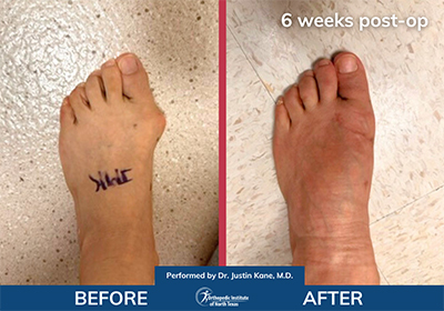 Minimally Invasive Bunion Surgery - Performed by Dr. Justin Kane at OINT