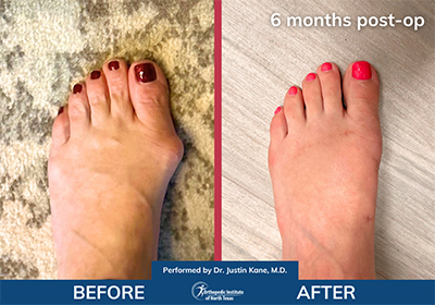 Minimally Invasive Bunion Surgery - Performed by Dr. Justin Kane at OINT