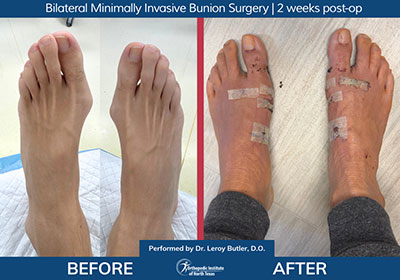 Minimally Invasive Bunion Surgery Bilateral - Performed by Dr. Justin Kane at OINT