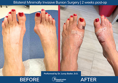 Minimally Invasive Bunion Surgery Bilateral - Performed by Dr. Justin Kane at OINT