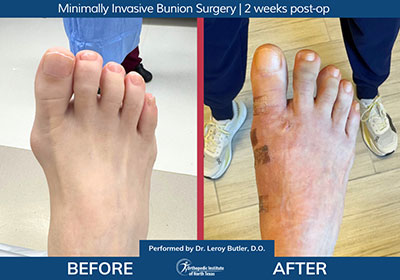 Minimally Invasive Bunion Surgery Bilateral - Performed by Dr. Justin Kane at OINT