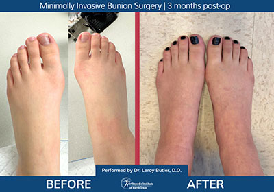 Minimally Invasive Bunion Surgery Bilateral - Performed by Dr. Justin Kane at OINT