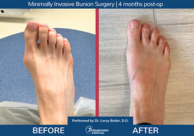 Minimally Invasive Bunion Surgery Bilateral - Performed by Dr. Justin Kane at OINT