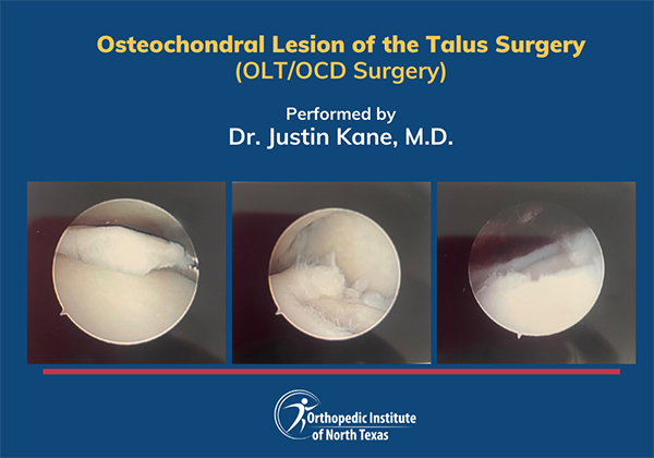 Arthroscopic images of damaged cartilage at a patient’s talus.