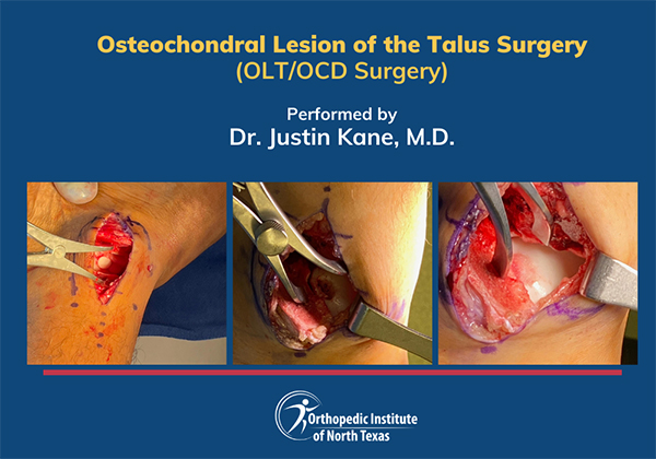 An open incision depicting the process of an open talus OCD/OCL procedure, also including the cartilage restoration procedure