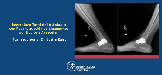 Reemplazo Total del Astrágalo Impreso en 3D en Frisco, Texas