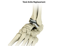 Ankle Joint Replacement