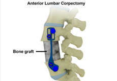 Anterior Lumbar Corpectomy and Fusion
