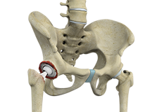 Hip Revision