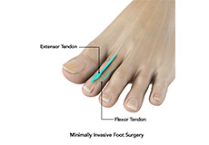 Minimally Invasive Foot Surgery