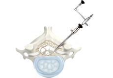 Posterior Cervical Microforaminotomy/Discectomy