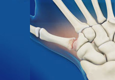 Surgery For Thumb And Digit Arthritis
